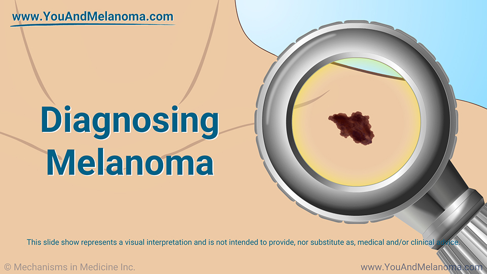 Diagnosing Melanoma - Download Slide Show