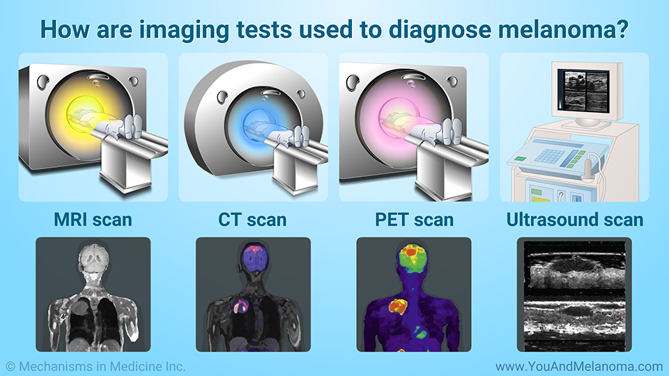 How are imaging tests used to diagnose melanoma?