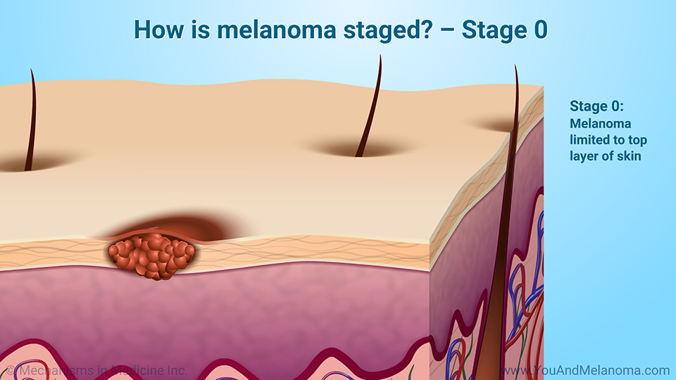 How is melanoma staged? – Stage 0
