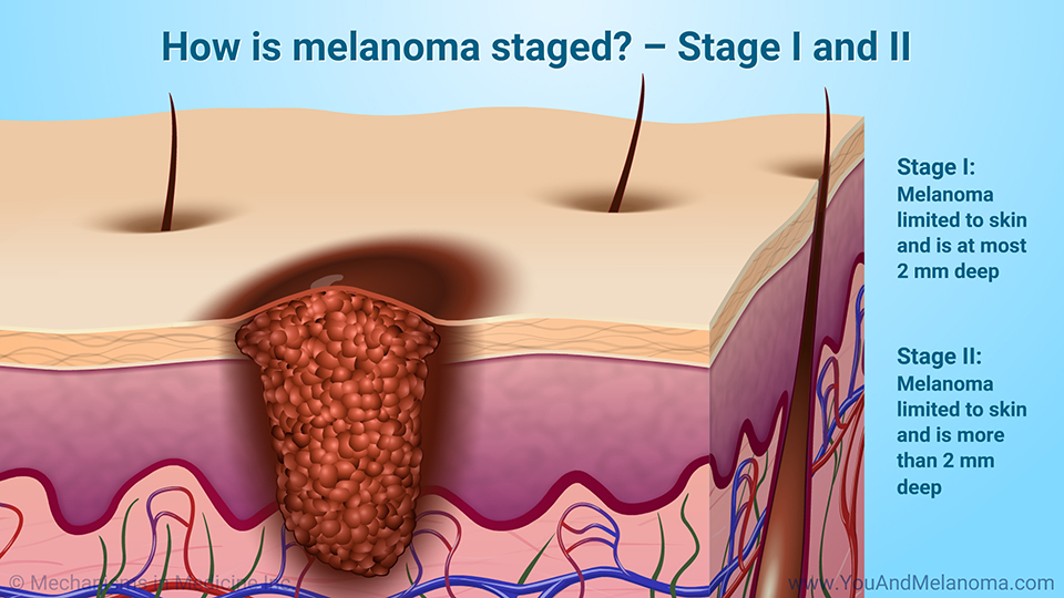 How is melanoma staged? – Stage I and II