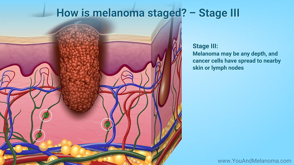 How is melanoma staged? – Stage III