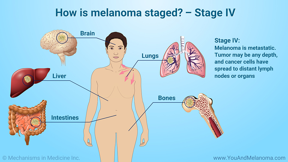 How is melanoma staged? – Stage IV