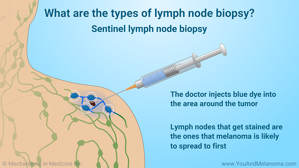 What are the types of lymph node biopsy?