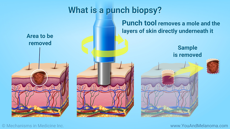 What is a punch biopsy?