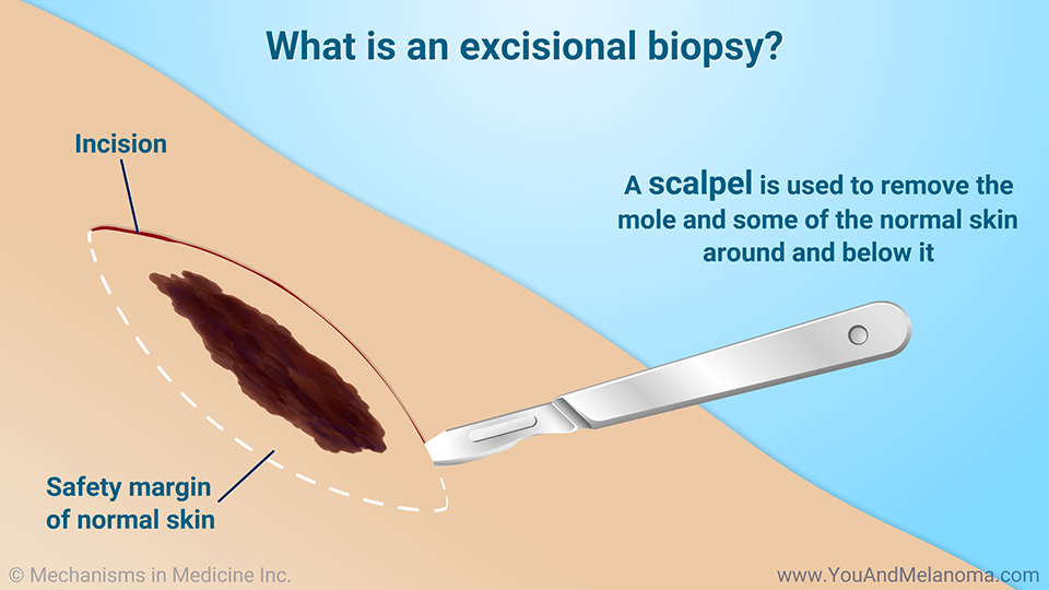 What is an excisional biopsy?