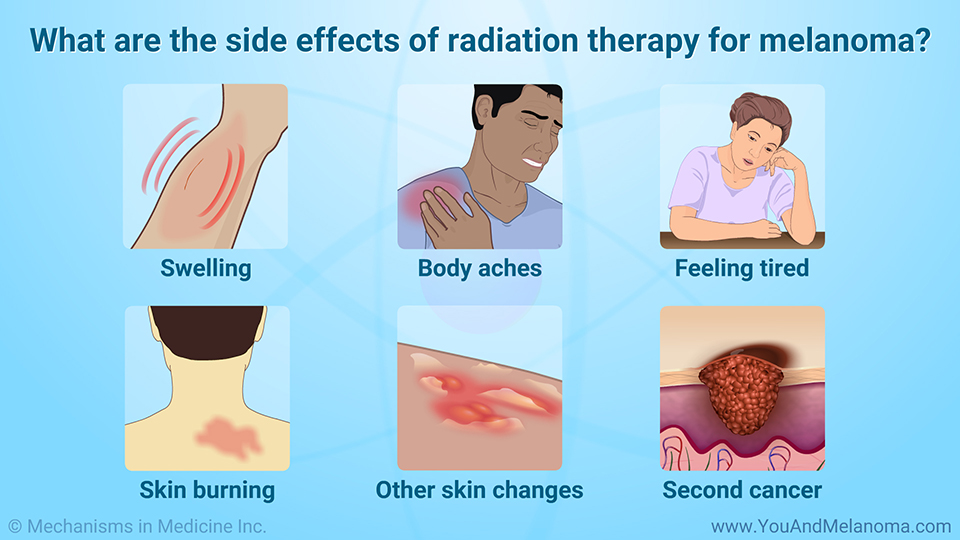 What are the side effects of radiation therapy for melanoma?