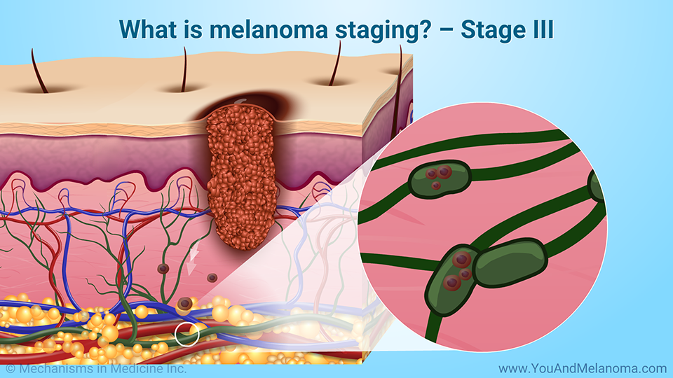 What is melanoma staging? – Stage III