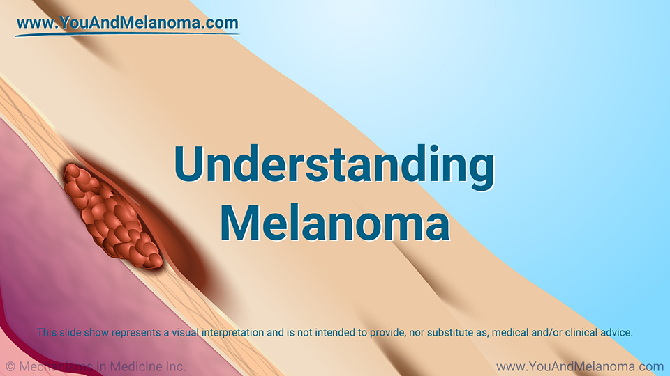 Understanding Melanoma - Download Slide Show