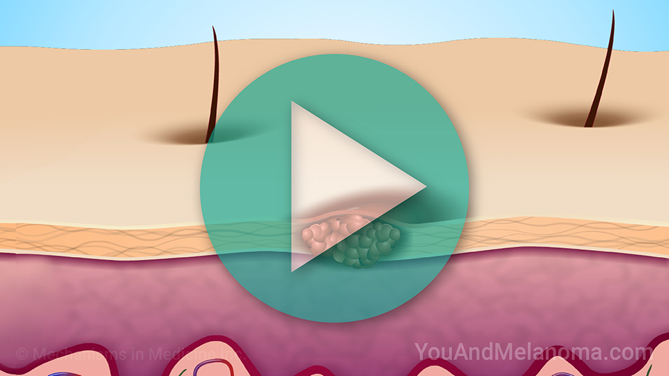 Understanding Melanoma