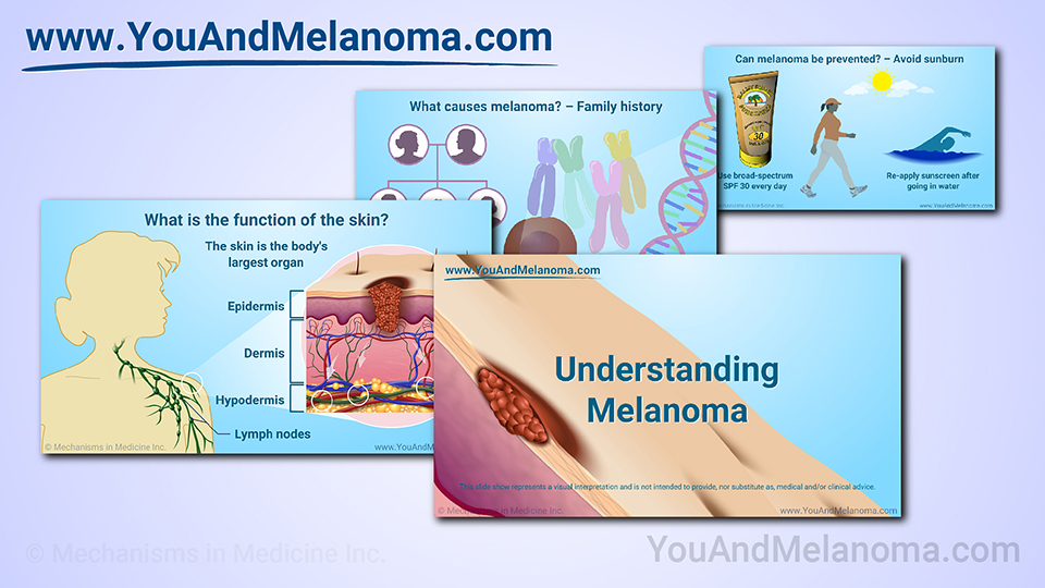 Slide Show - Understanding Melanoma