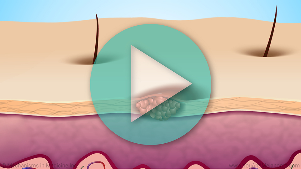 Animation - Understanding Melanoma