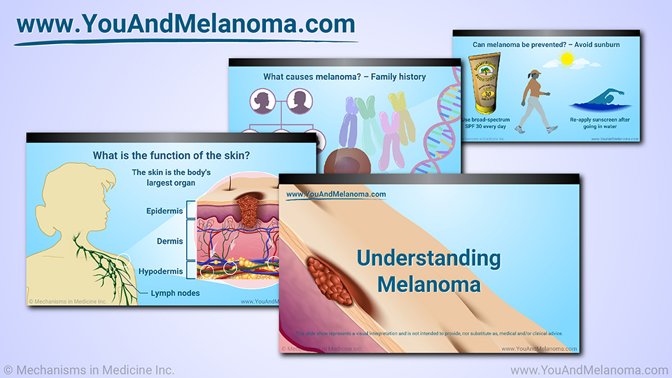 Slide Show - Understanding Melanoma