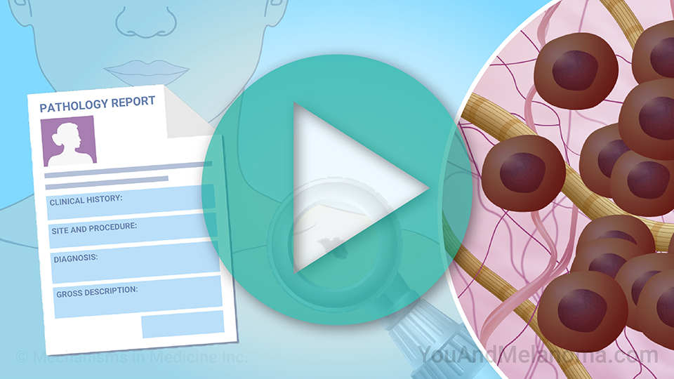 Diagnosing Melanoma