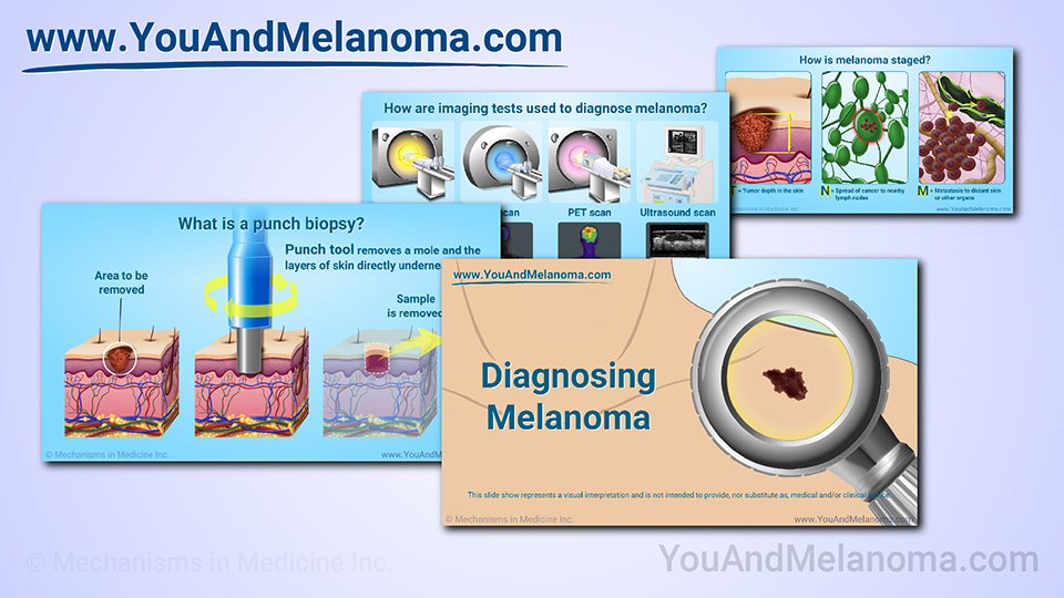Slide Show - Diagnosing Melanoma