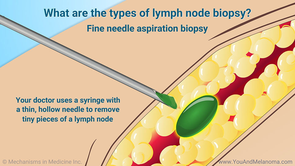Slide Show - Diagnosing Melanoma