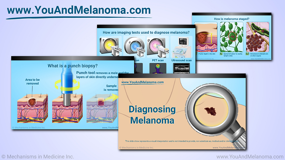 Slide Show - Diagnosing Melanoma