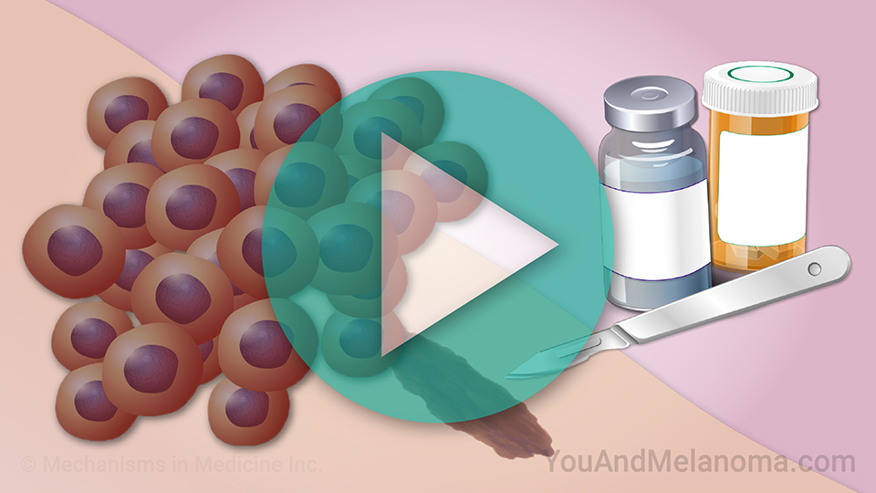 Treating Melanoma