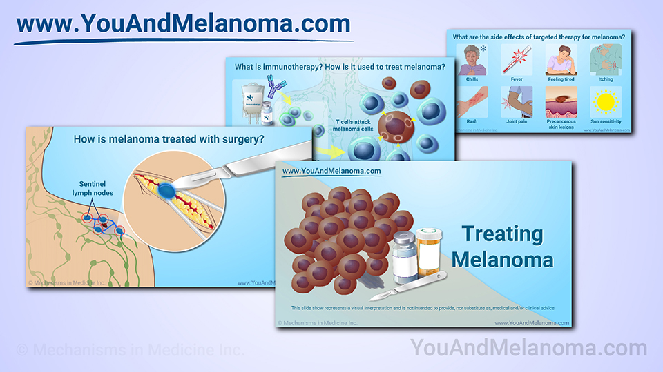 Slide Show - Treating Melanoma