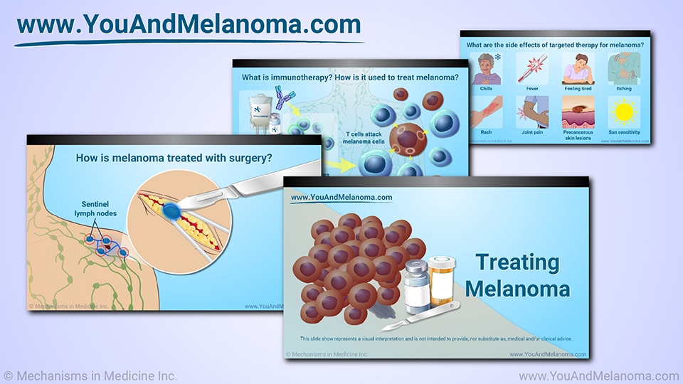 Slide Show - Treating Melanoma