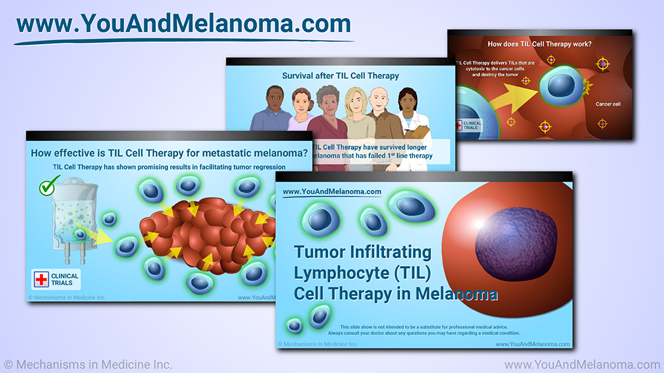 Slide Show - TIL Cell Therapy for Melanoma