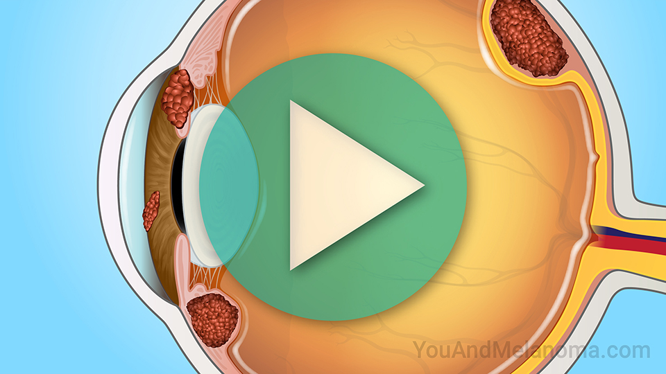Animation — Understanding Metastatic Uveal Melanoma