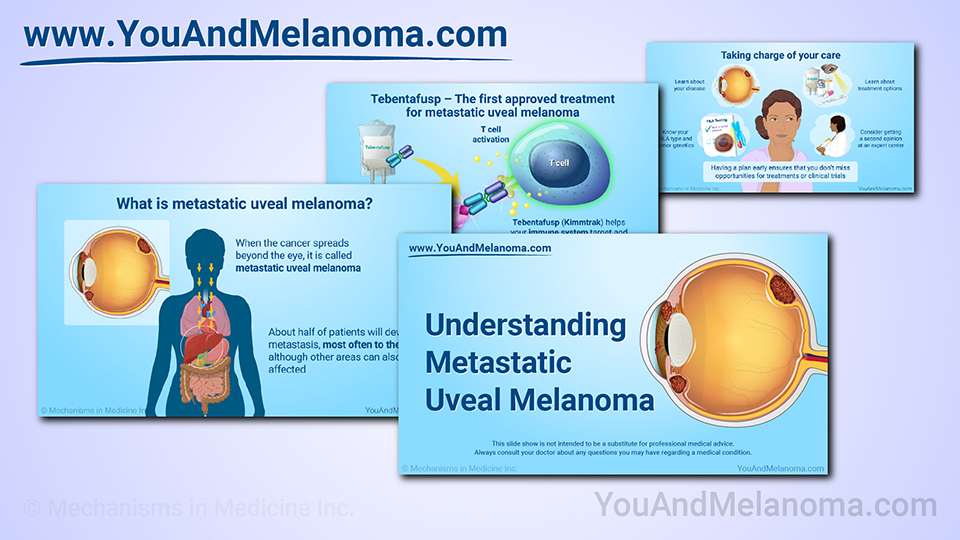 Slide Show — Understanding Metastatic Uveal Melanoma