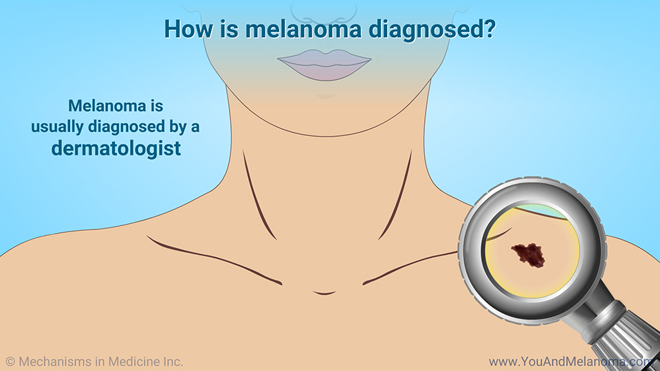 How is melanoma diagnosed?