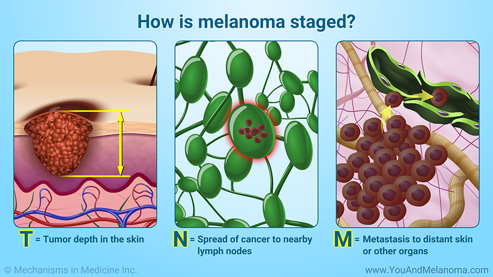 How is melanoma staged? - TNM