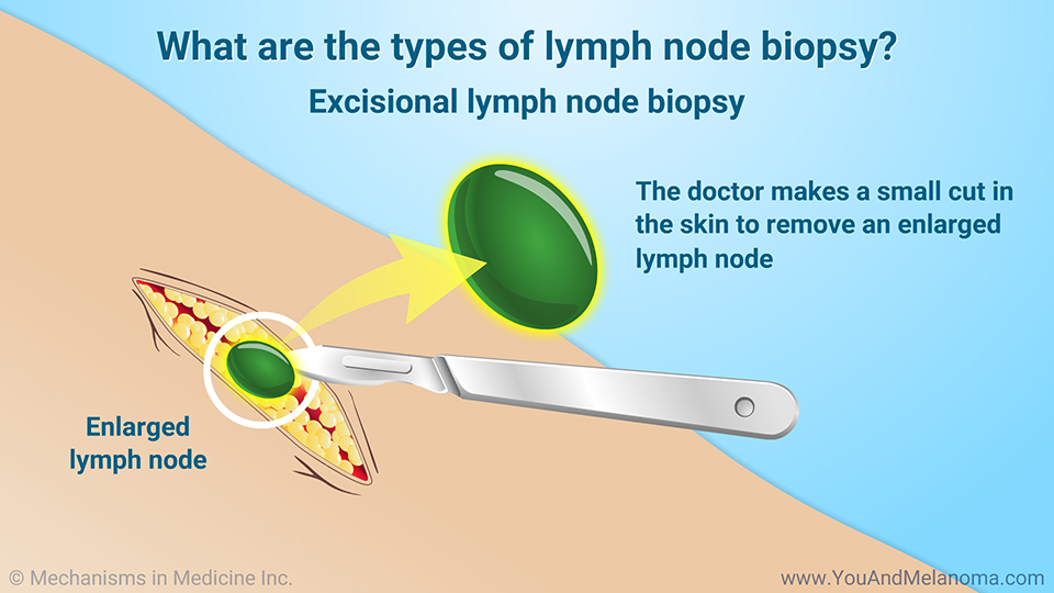 What are the types of lymph node biopsy?