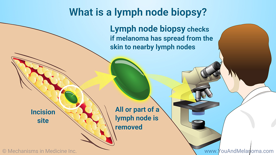 What is a lymph node biopsy?