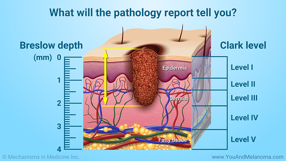 What will the pathology report tell you?