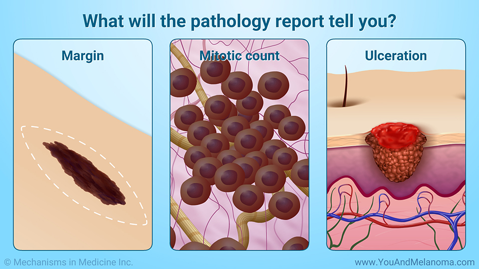 What will the pathology report tell you?
