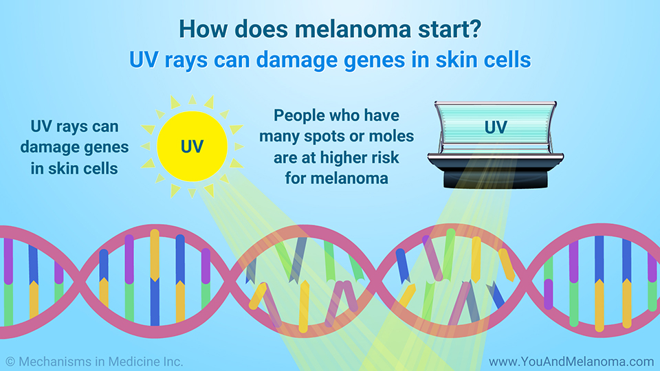 How does melanoma start? UV rays can damage genes in skin cells