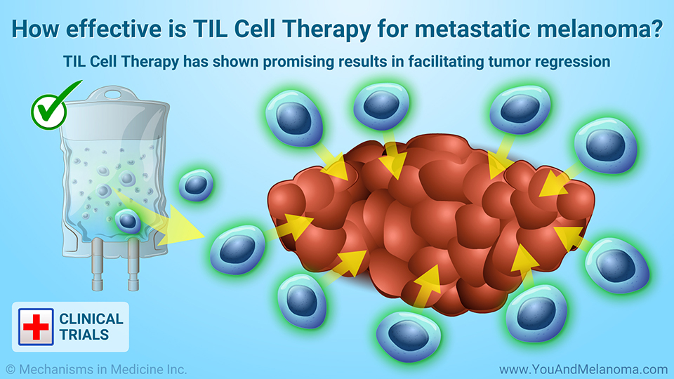 How effective is TIL Cell Therapy for metastatic melanoma?