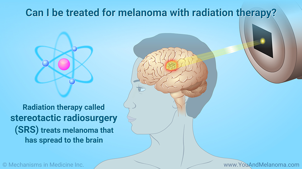 Can I be treated for melanoma with radiation therapy?