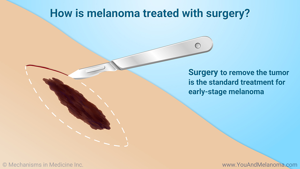 How is melanoma treated with surgery?