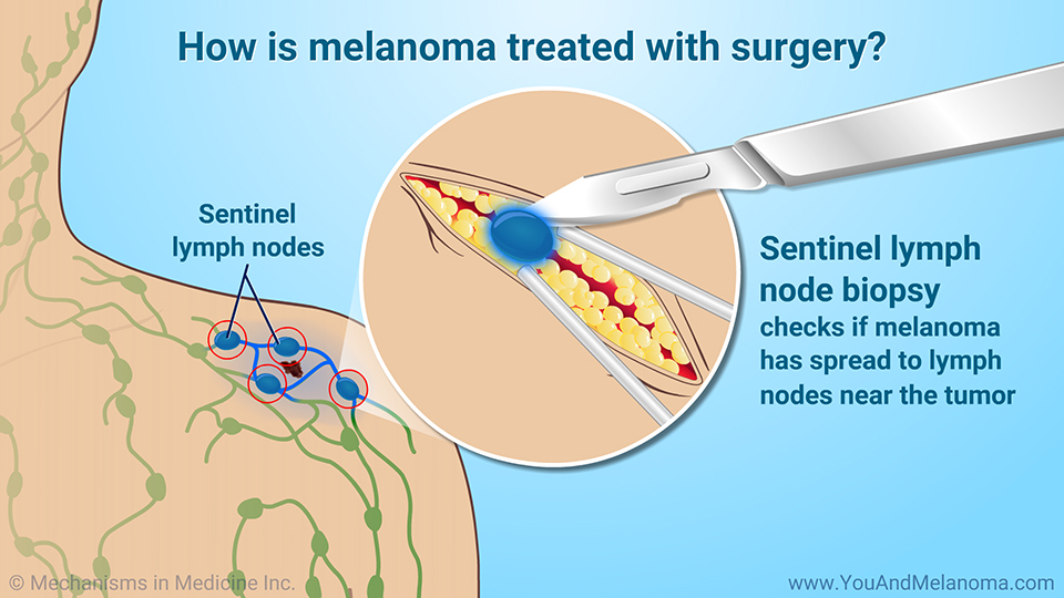 How is melanoma treated with surgery? 