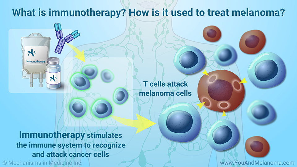 What is immunotherapy? How is it used to treat melanoma? 