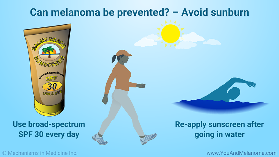 Can melanoma be prevented? – Avoid sunburn