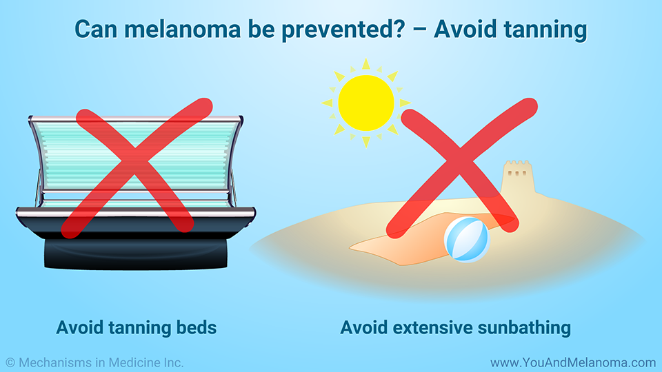 Can melanoma be prevented? – Avoid tanning