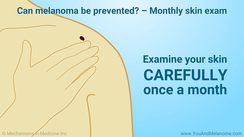 Can melanoma be prevented? – Monthly skin exam