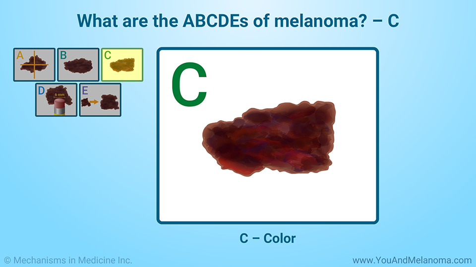 What are the ABCDEs of melanoma? – C