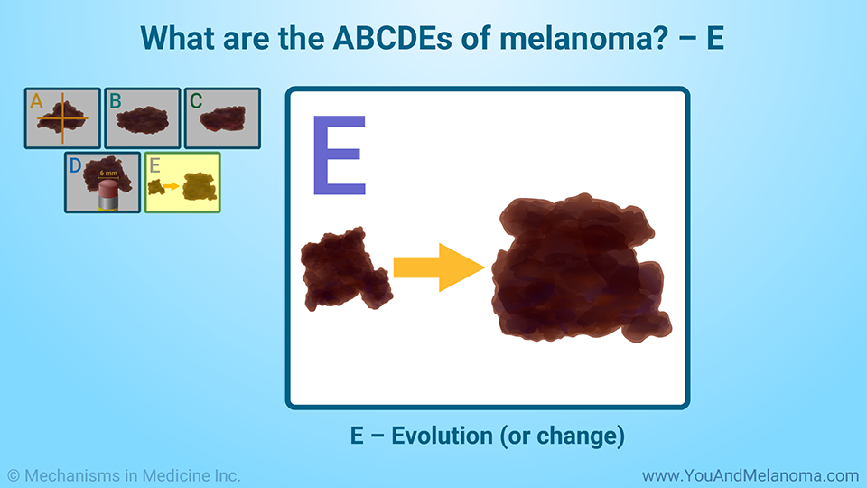 What are the ABCDEs of melanoma? – E