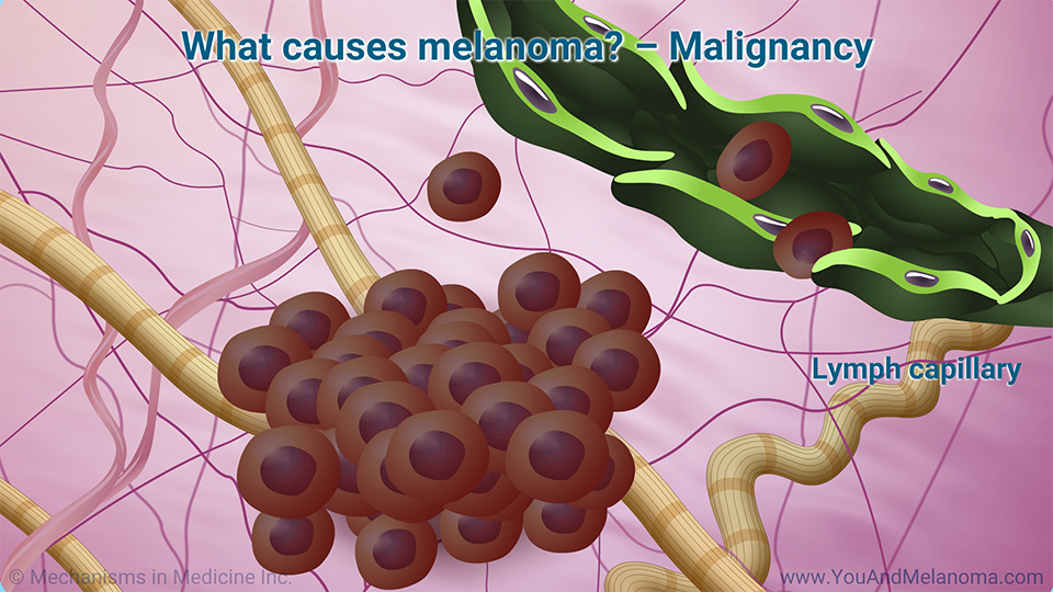 What causes melanoma?       – Malignancy
