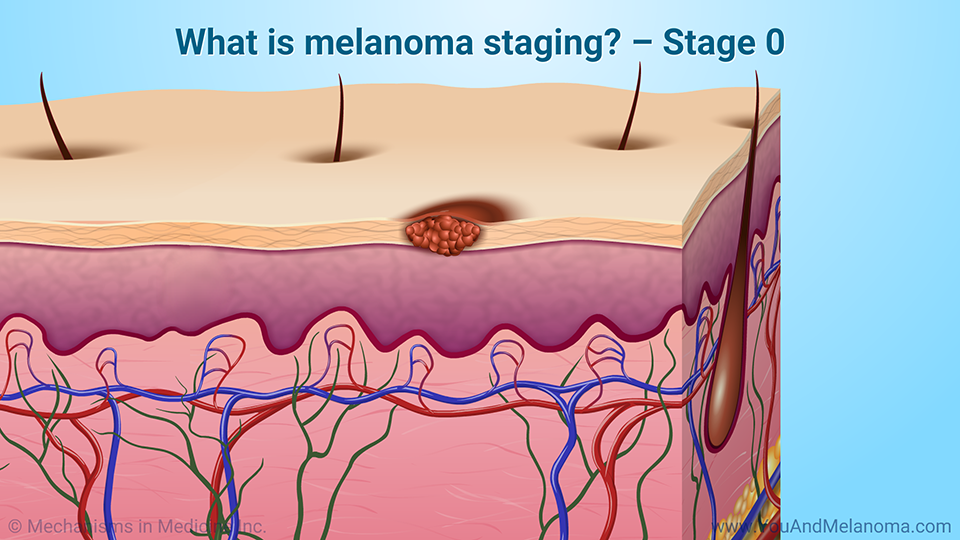 What is melanoma staging? – Stage 0
